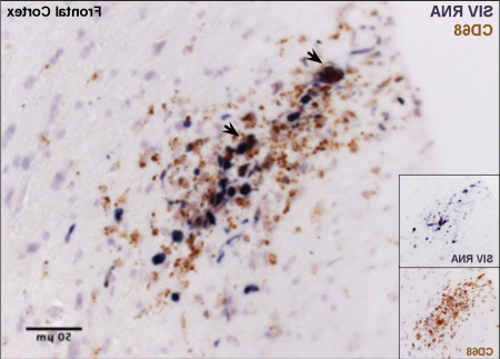 SIV-infected macrophages comprise lesions in the frontal cortex of an SIV-infected rhesus macaque that developed AIDS with SIV-associated encephalitis.